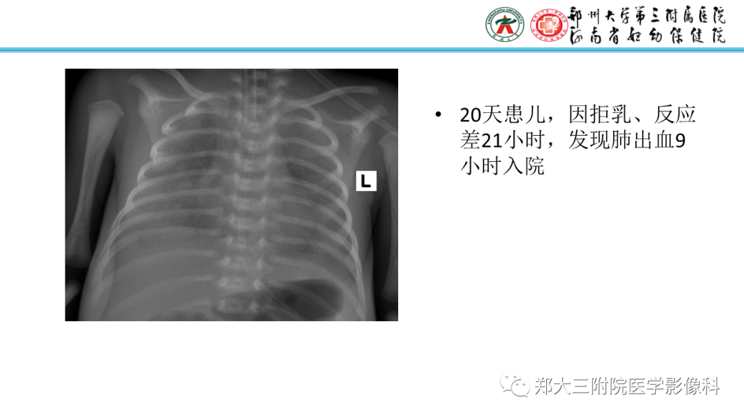 影像PPT - 【PPT】新生儿呼吸窘迫综合征床旁胸片诊断-24
