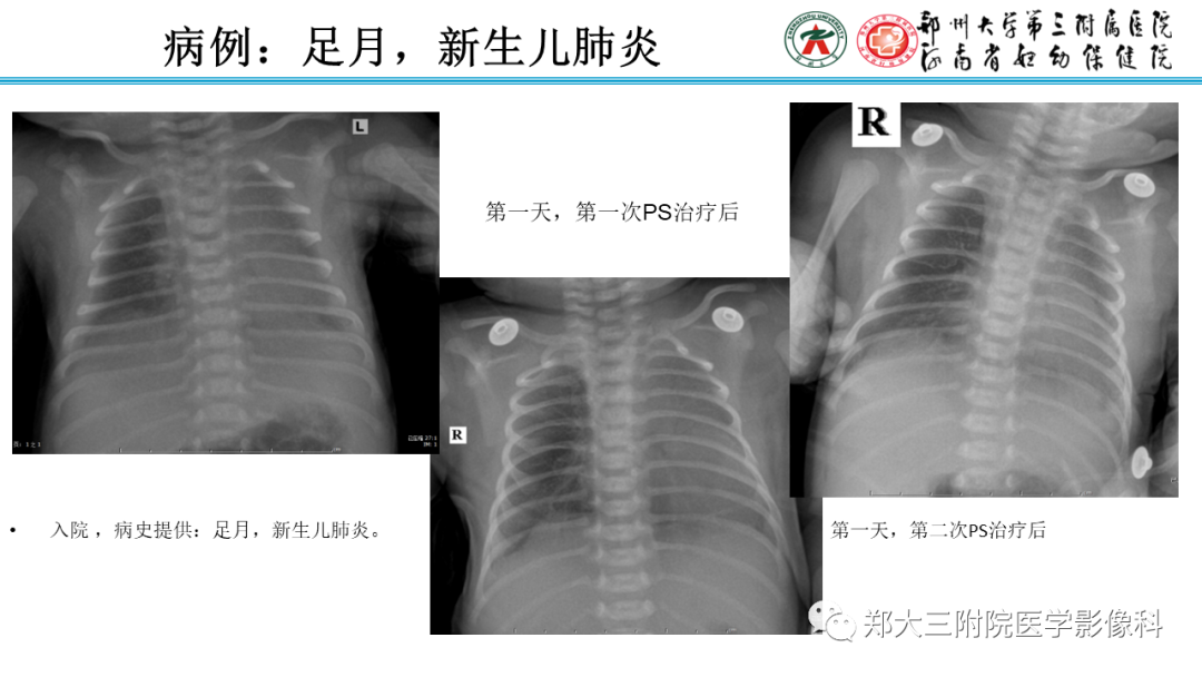 影像PPT - 【PPT】新生儿呼吸窘迫综合征床旁胸片诊断-28
