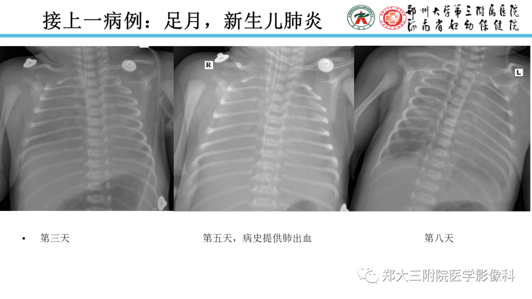 影像PPT - 【PPT】新生儿呼吸窘迫综合征床旁胸片诊断-29