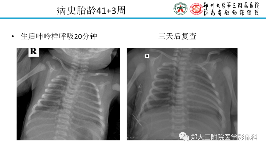影像PPT - 【PPT】新生儿呼吸窘迫综合征床旁胸片诊断-32