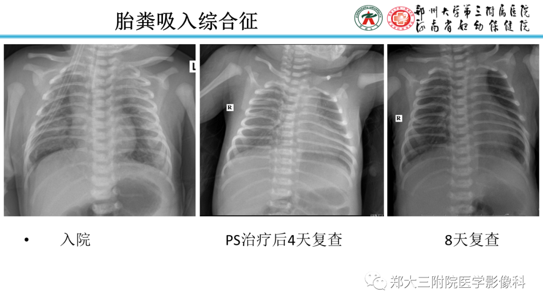 影像PPT - 【PPT】新生儿呼吸窘迫综合征床旁胸片诊断-35