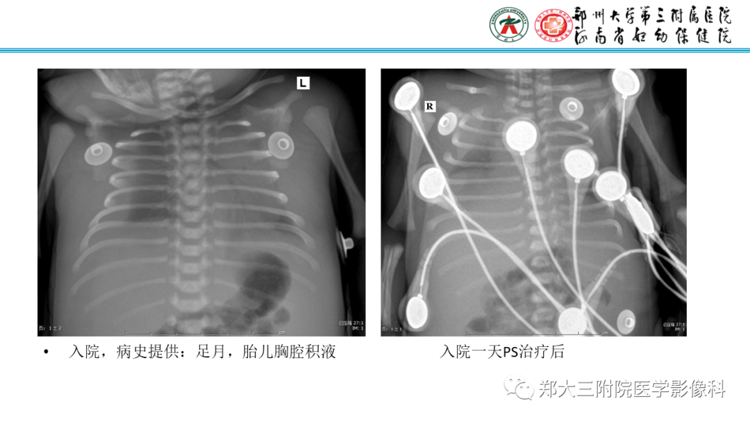 影像PPT - 【PPT】新生儿呼吸窘迫综合征床旁胸片诊断-37