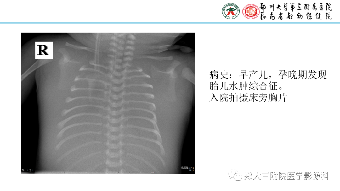 影像PPT - 【PPT】新生儿呼吸窘迫综合征床旁胸片诊断-38
