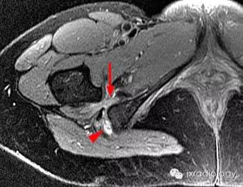 影像PPT - 坐骨股骨撞击综合征(IFI)-4 影像PPT - 坐骨股骨撞击综合征(IFI)-4