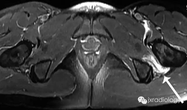 影像PPT - 坐骨股骨撞击综合征(IFI)-9 影像PPT - 坐骨股骨撞击综合征(IFI)-9