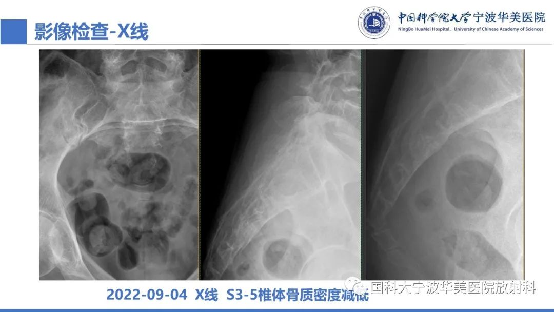 影像PPT - 【病例】骶椎脊索瘤1例CT及MR影像-6