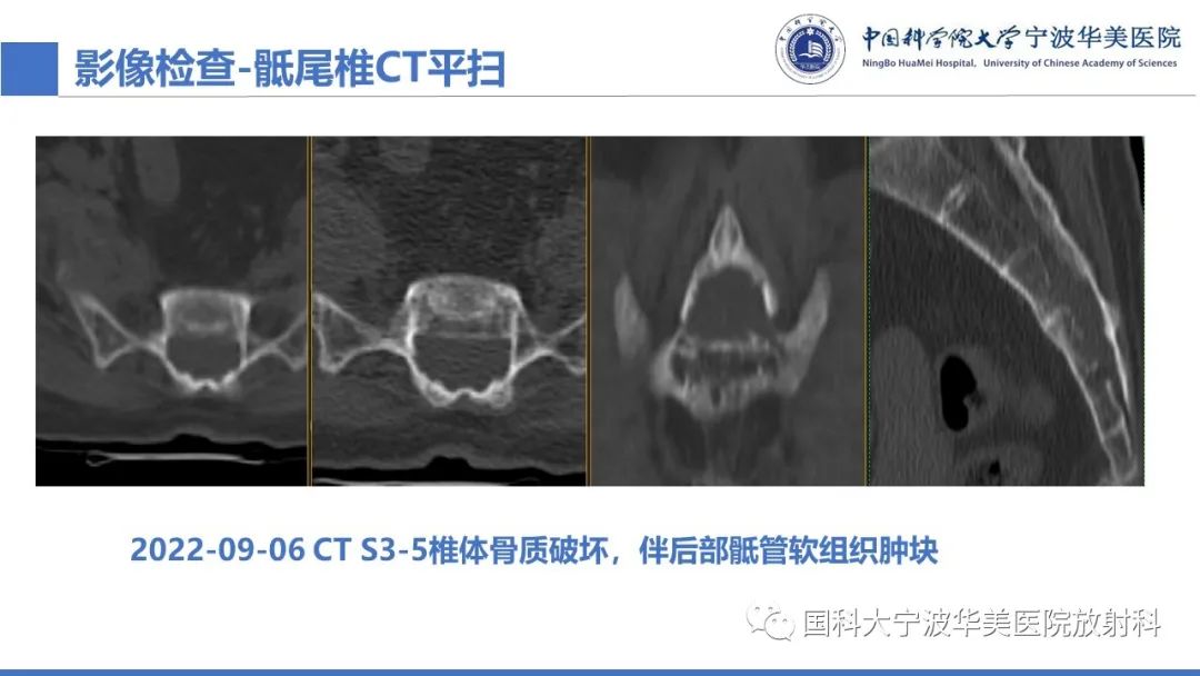 影像PPT - 【病例】骶椎脊索瘤1例CT及MR影像-7