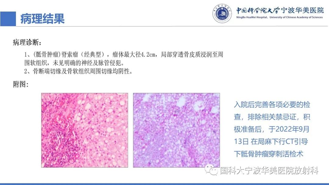 影像PPT - 【病例】骶椎脊索瘤1例CT及MR影像-10