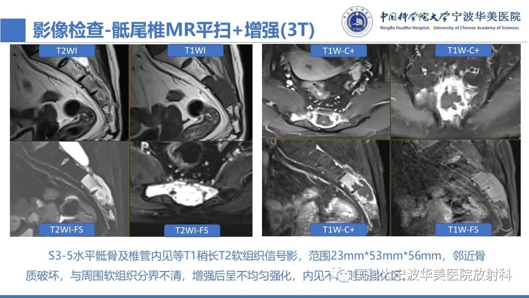 影像PPT - 【病例】骶椎脊索瘤1例CT及MR影像-8