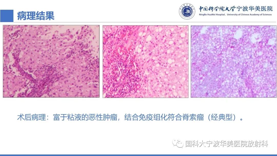 影像PPT - 【病例】骶椎脊索瘤1例CT及MR影像-11