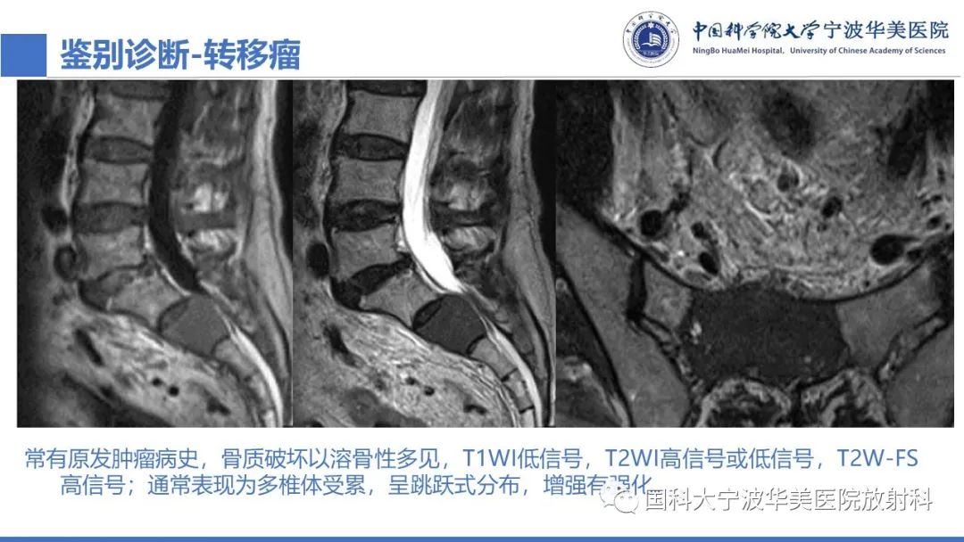 影像PPT - 【病例】骶椎脊索瘤1例CT及MR影像-14