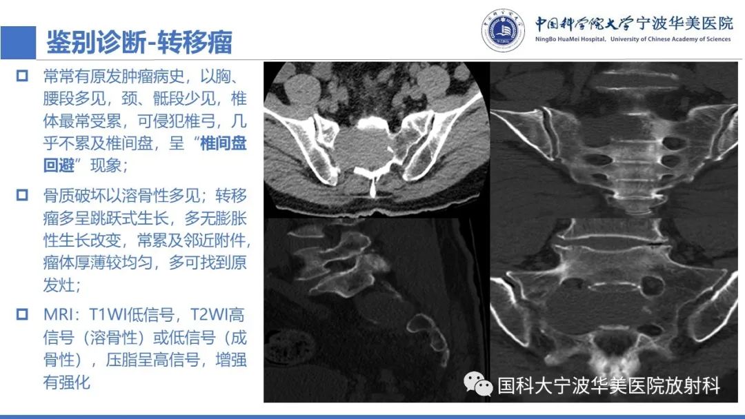 影像PPT - 【病例】骶椎脊索瘤1例CT及MR影像-13