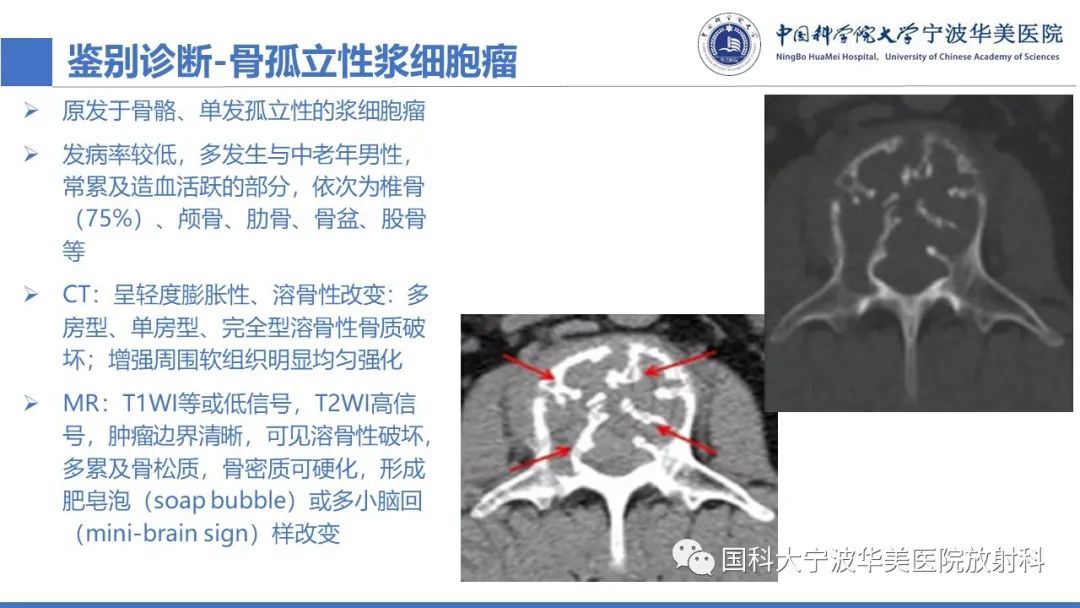 影像PPT - 【病例】骶椎脊索瘤1例CT及MR影像-15
