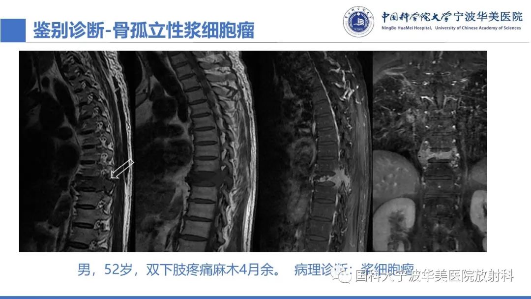 影像PPT - 【病例】骶椎脊索瘤1例CT及MR影像-16