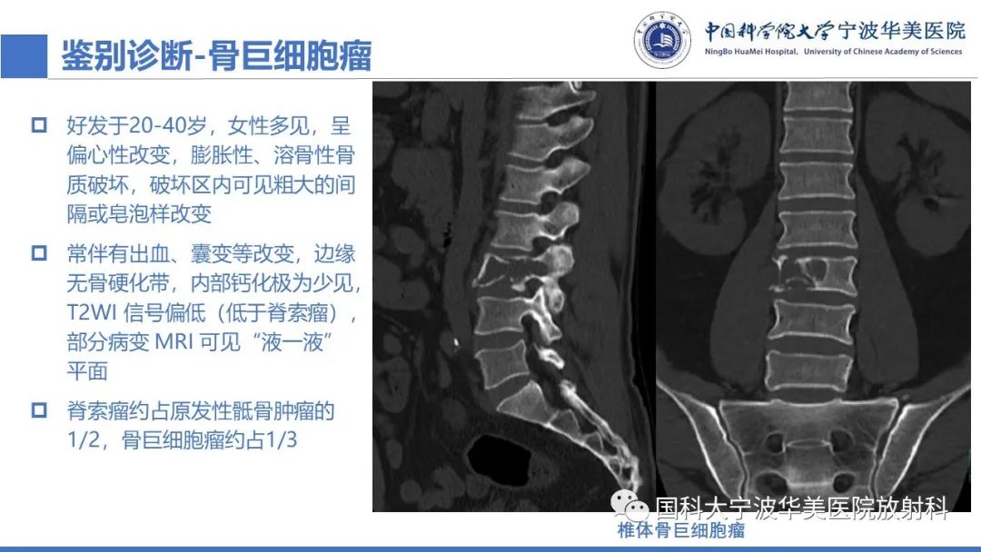影像PPT - 【病例】骶椎脊索瘤1例CT及MR影像-17