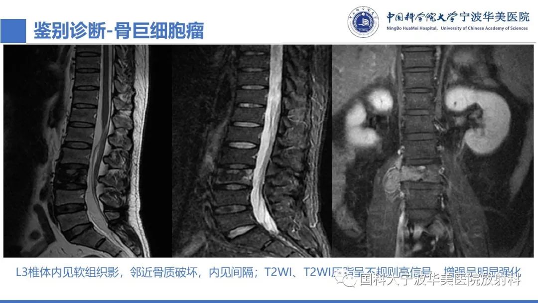 影像PPT - 【病例】骶椎脊索瘤1例CT及MR影像-18