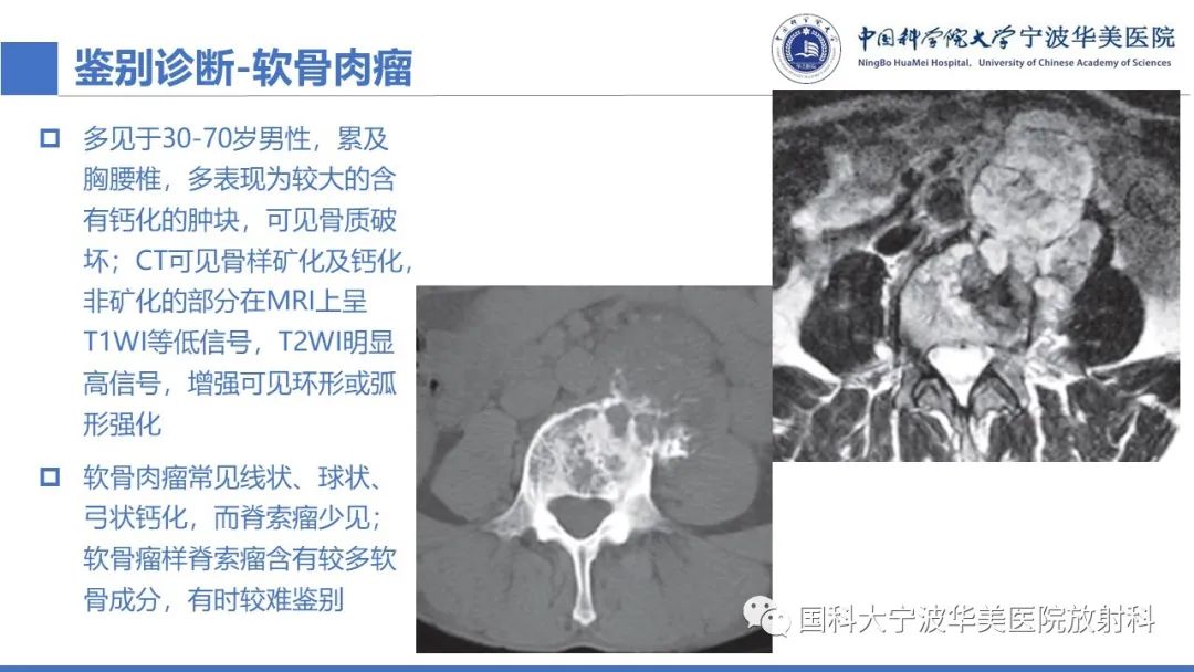 影像PPT - 【病例】骶椎脊索瘤1例CT及MR影像-19