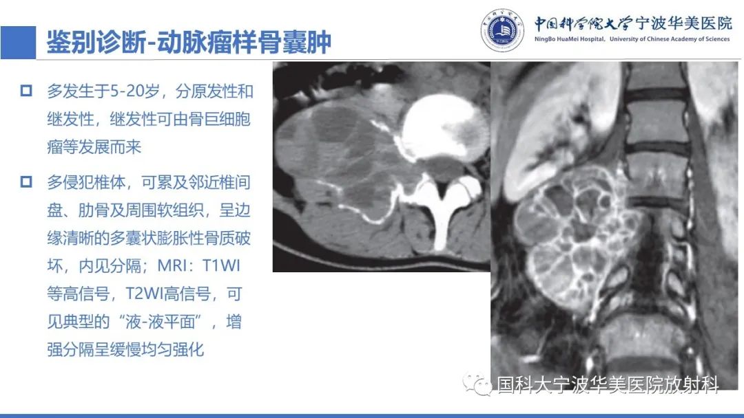 影像PPT - 【病例】骶椎脊索瘤1例CT及MR影像-20