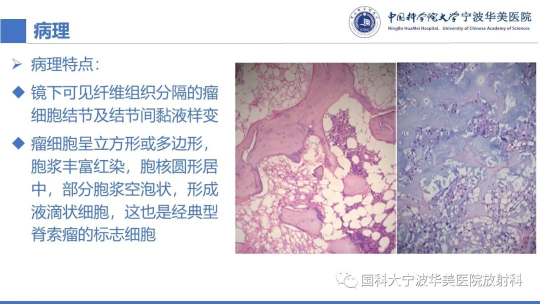 影像PPT - 【病例】骶椎脊索瘤1例CT及MR影像-26