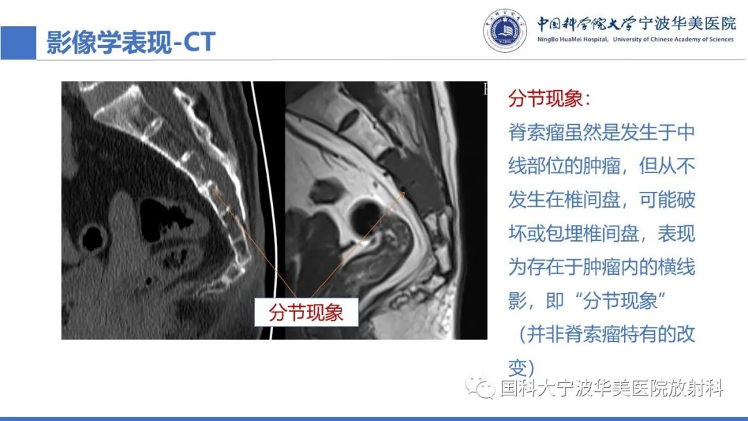 影像PPT - 【病例】骶椎脊索瘤1例CT及MR影像-30