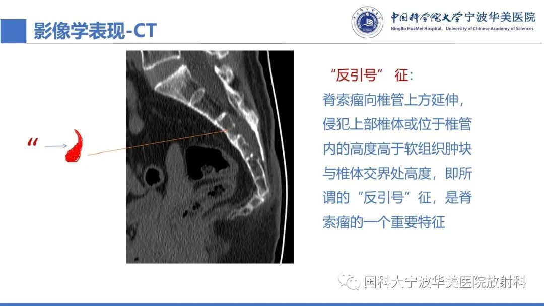 影像PPT - 【病例】骶椎脊索瘤1例CT及MR影像-29