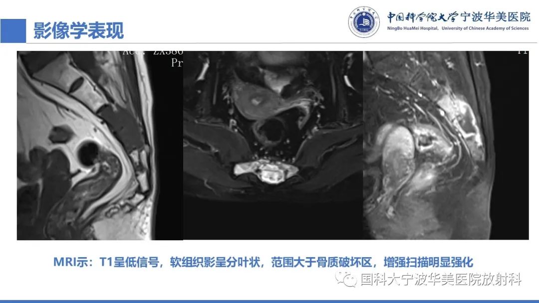 影像PPT - 【病例】骶椎脊索瘤1例CT及MR影像-31