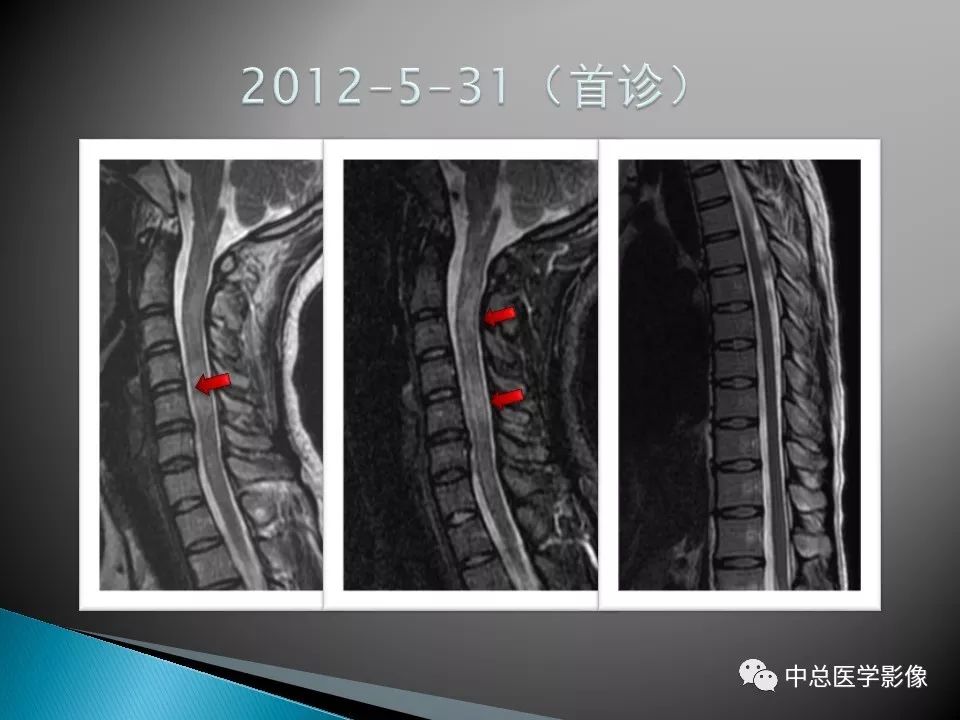 影像PPT - 【PPT】视神经脊髓炎：临床经过与MRI动态表现-5