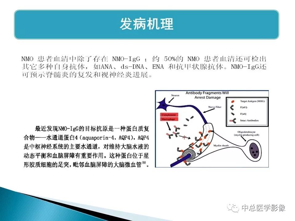 影像PPT - 【PPT】视神经脊髓炎：临床经过与MRI动态表现-3