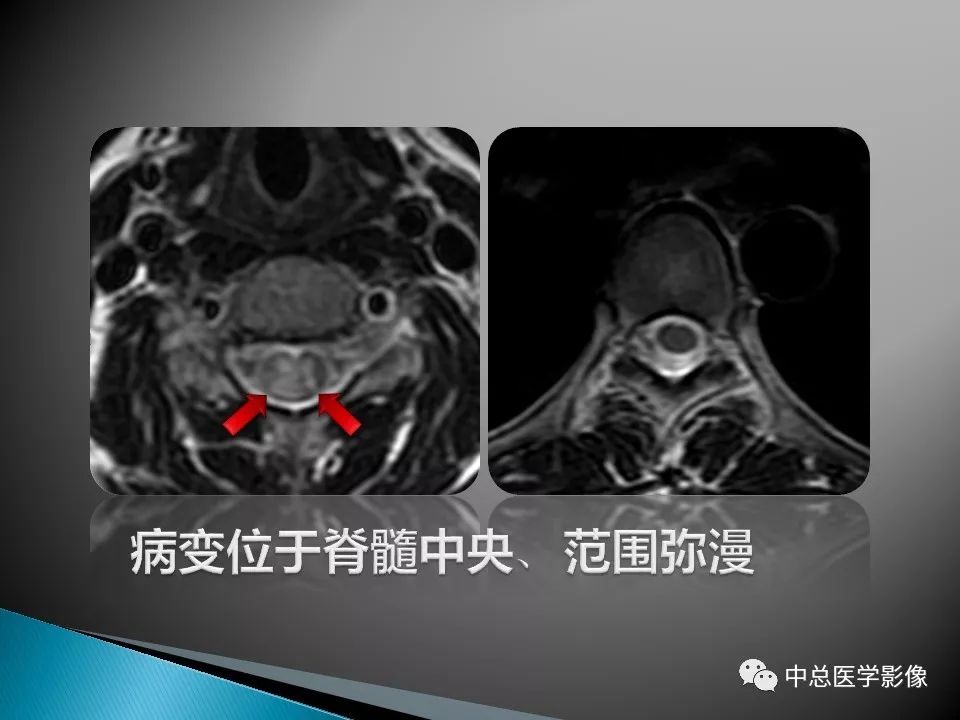 影像PPT - 【PPT】视神经脊髓炎：临床经过与MRI动态表现-6
