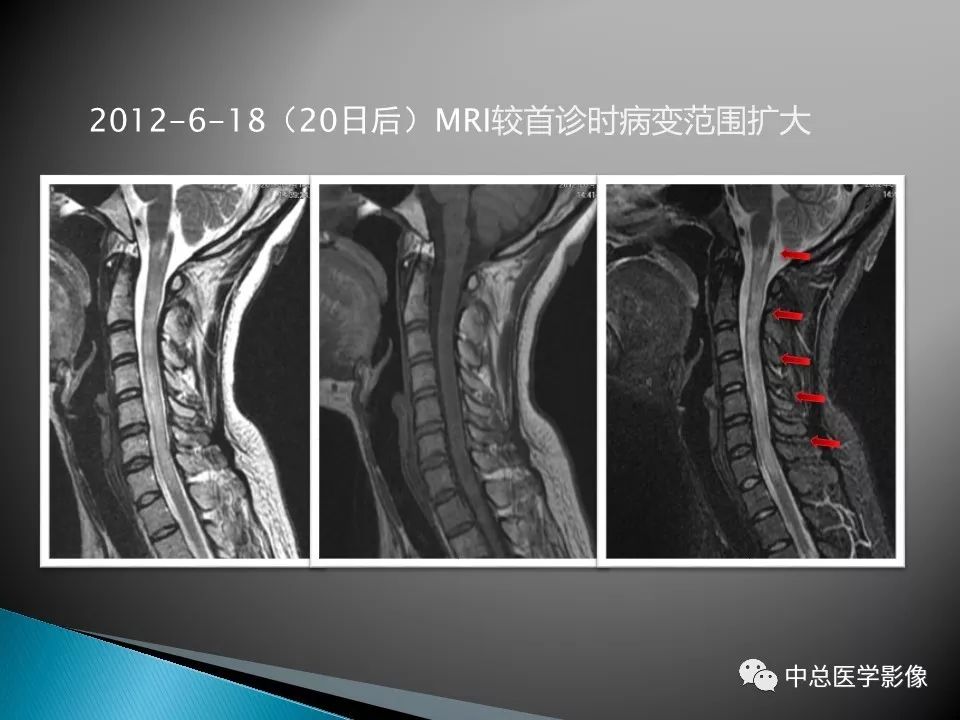 影像PPT - 【PPT】视神经脊髓炎：临床经过与MRI动态表现-7