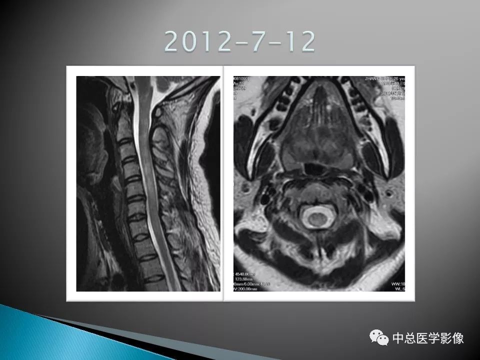 影像PPT - 【PPT】视神经脊髓炎：临床经过与MRI动态表现-8