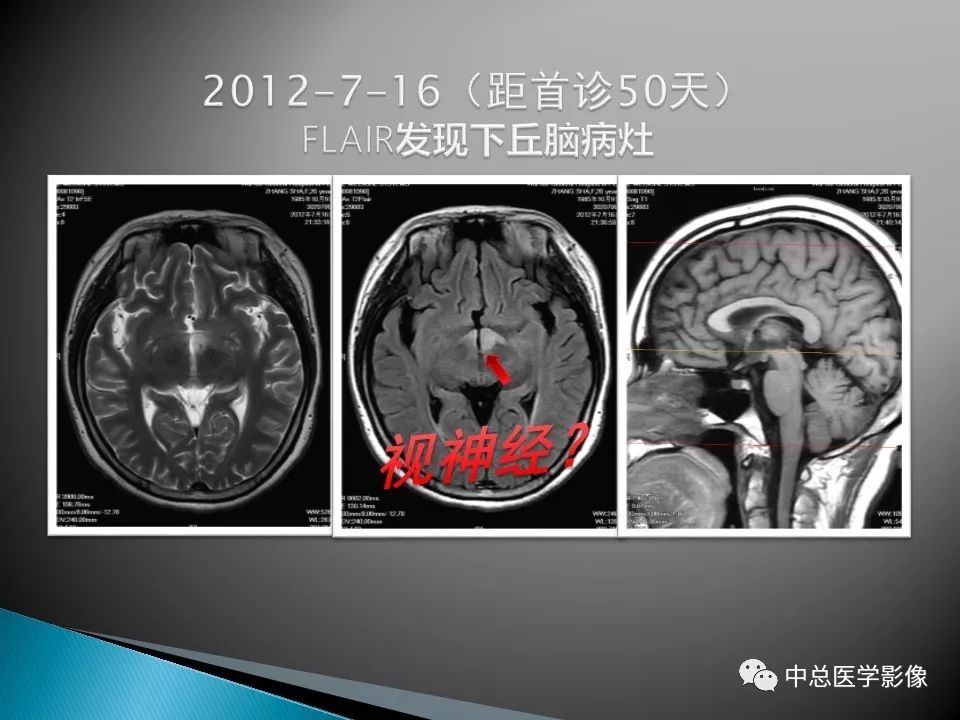 影像PPT - 【PPT】视神经脊髓炎：临床经过与MRI动态表现-10