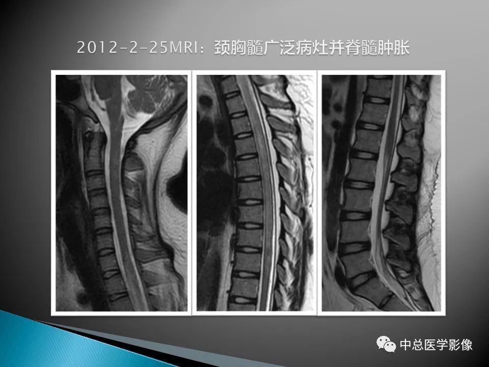 影像PPT - 【PPT】视神经脊髓炎：临床经过与MRI动态表现-12