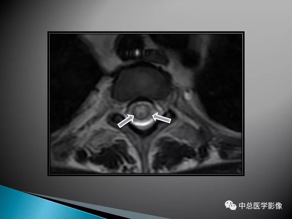 影像PPT - 【PPT】视神经脊髓炎：临床经过与MRI动态表现-13