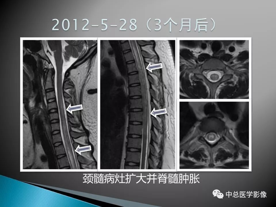 影像PPT - 【PPT】视神经脊髓炎：临床经过与MRI动态表现-14