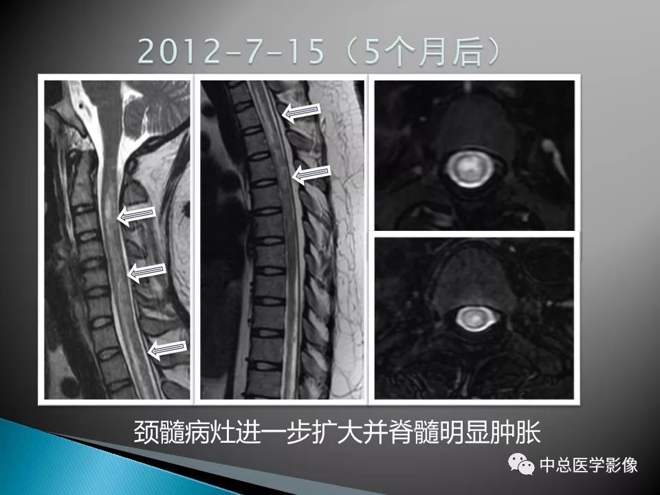 影像PPT - 【PPT】视神经脊髓炎：临床经过与MRI动态表现-15