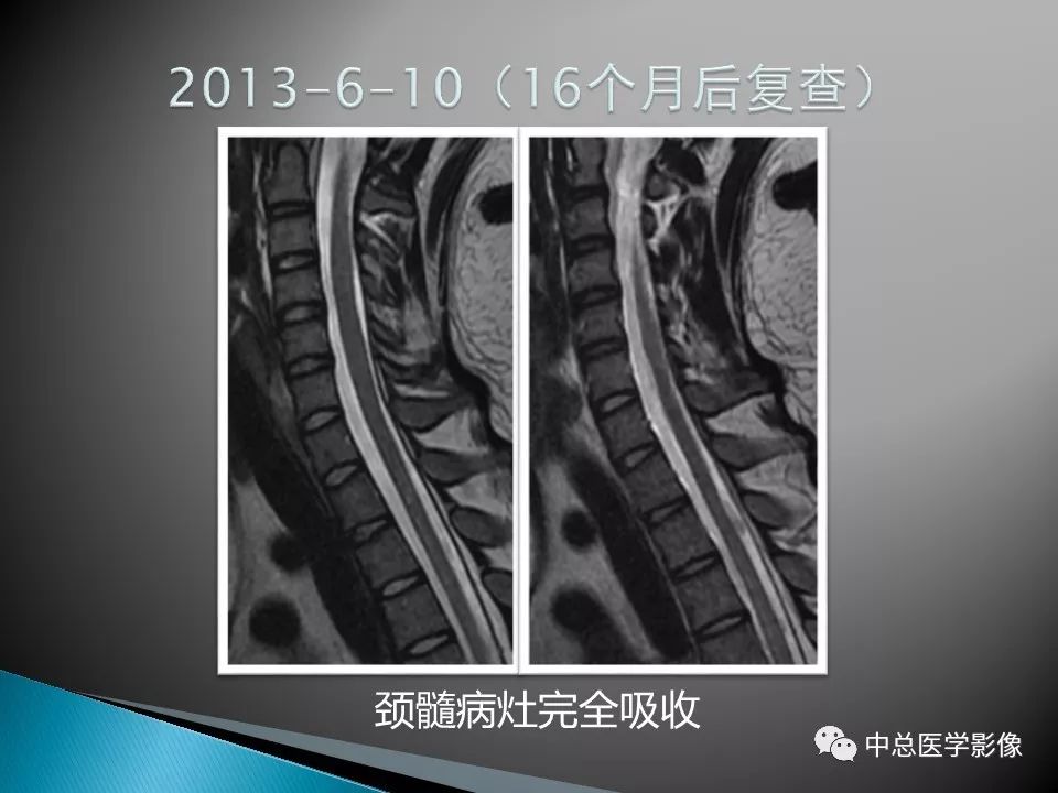 影像PPT - 【PPT】视神经脊髓炎：临床经过与MRI动态表现-16