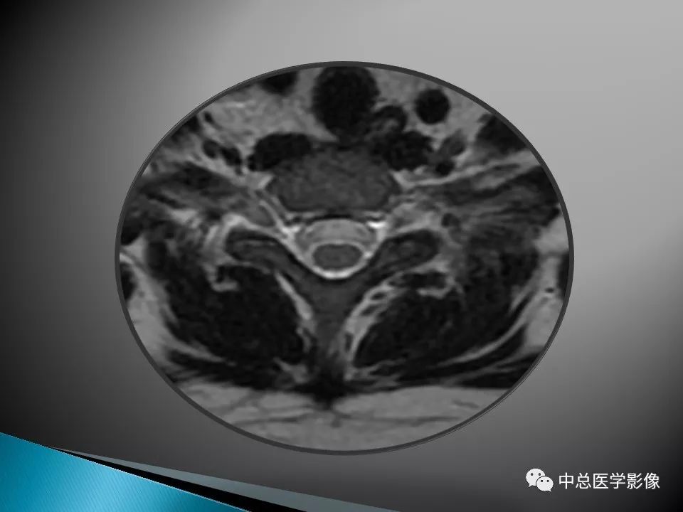 影像PPT - 【PPT】视神经脊髓炎：临床经过与MRI动态表现-17