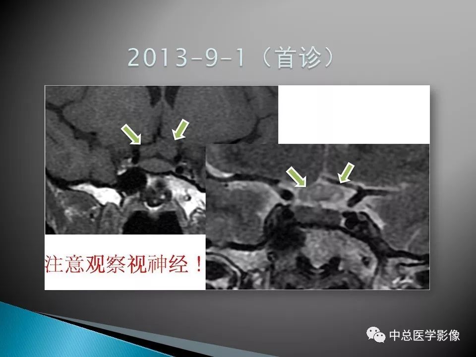 影像PPT - 【PPT】视神经脊髓炎：临床经过与MRI动态表现-20