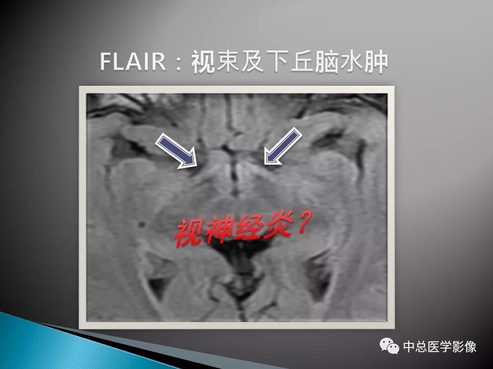 影像PPT - 【PPT】视神经脊髓炎：临床经过与MRI动态表现-21