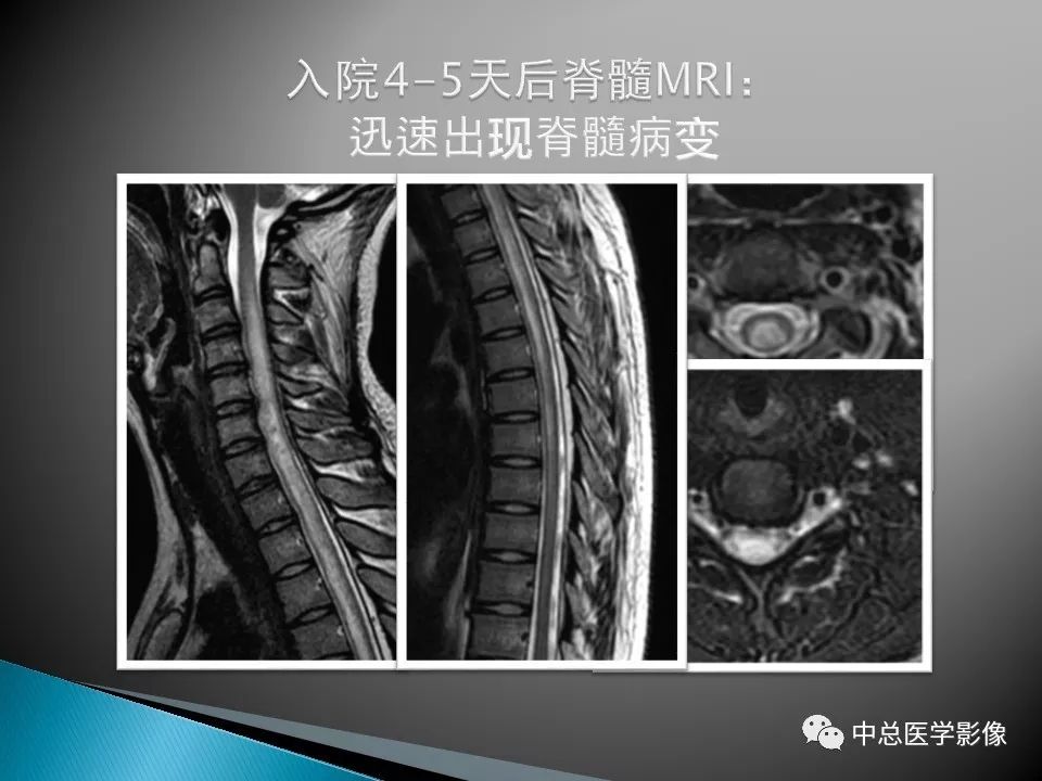 影像PPT - 【PPT】视神经脊髓炎：临床经过与MRI动态表现-22