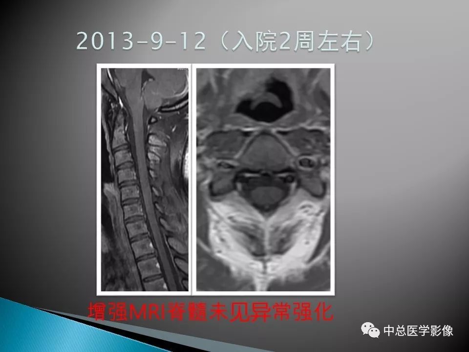 影像PPT - 【PPT】视神经脊髓炎：临床经过与MRI动态表现-23