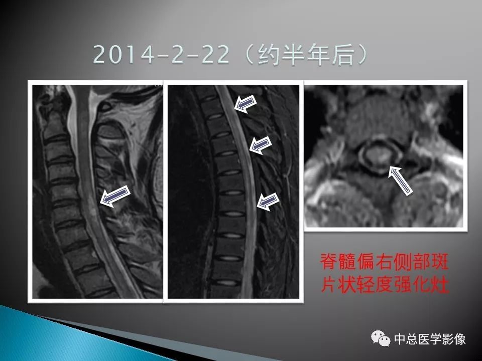 影像PPT - 【PPT】视神经脊髓炎：临床经过与MRI动态表现-26