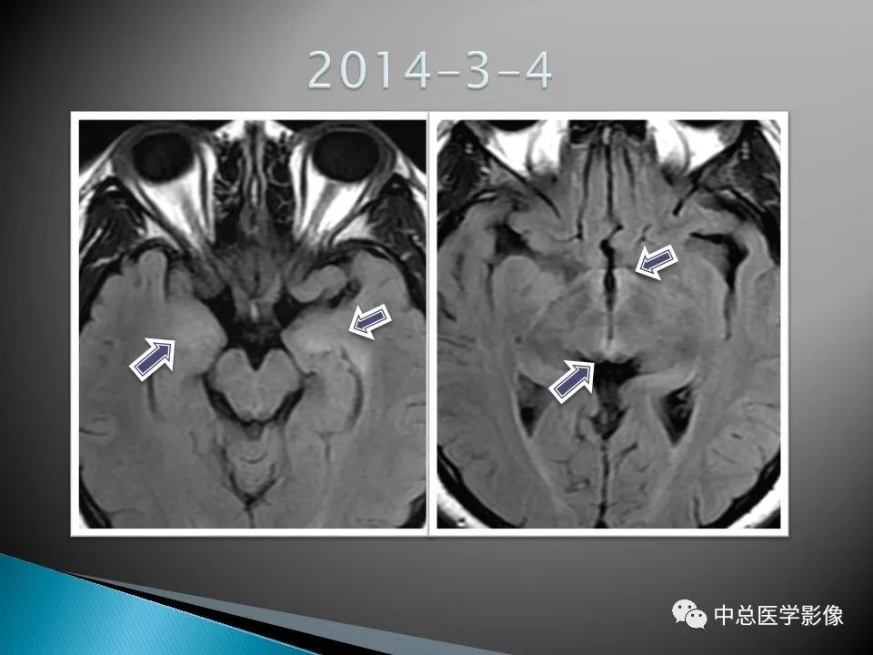 影像PPT - 【PPT】视神经脊髓炎：临床经过与MRI动态表现-27