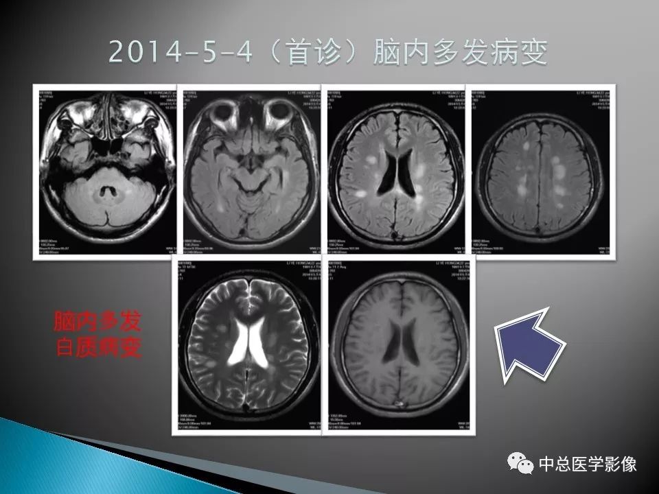 影像PPT - 【PPT】视神经脊髓炎：临床经过与MRI动态表现-29