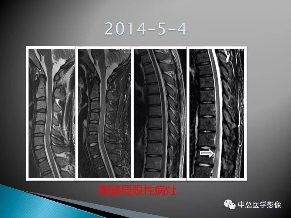 影像PPT - 【PPT】视神经脊髓炎：临床经过与MRI动态表现-30