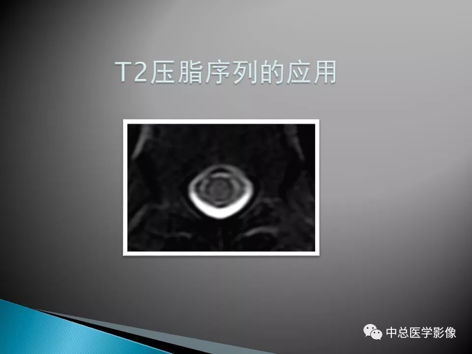 影像PPT - 【PPT】视神经脊髓炎：临床经过与MRI动态表现-31