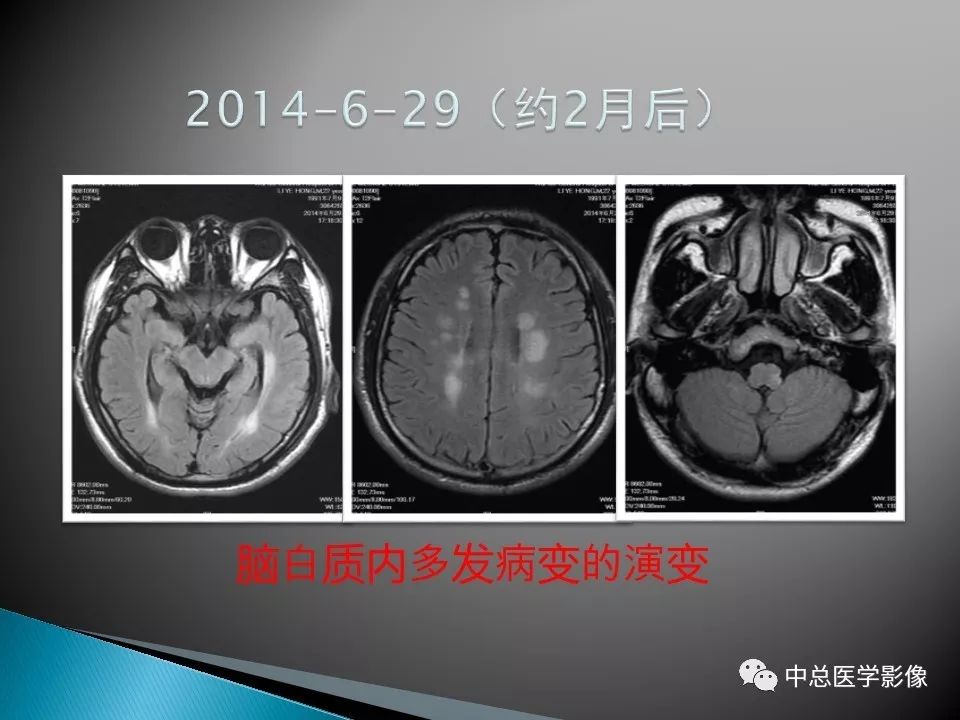 影像PPT - 【PPT】视神经脊髓炎：临床经过与MRI动态表现-33