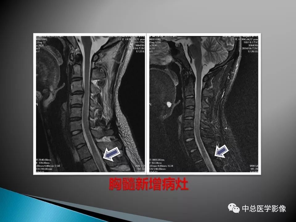 影像PPT - 【PPT】视神经脊髓炎：临床经过与MRI动态表现-34