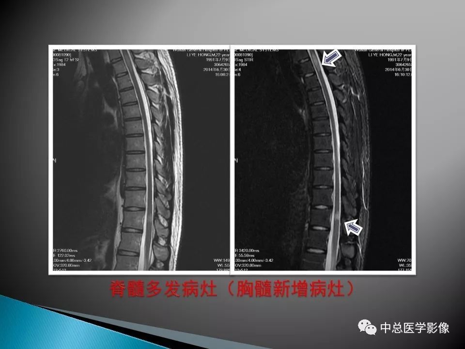 影像PPT - 【PPT】视神经脊髓炎：临床经过与MRI动态表现-35
